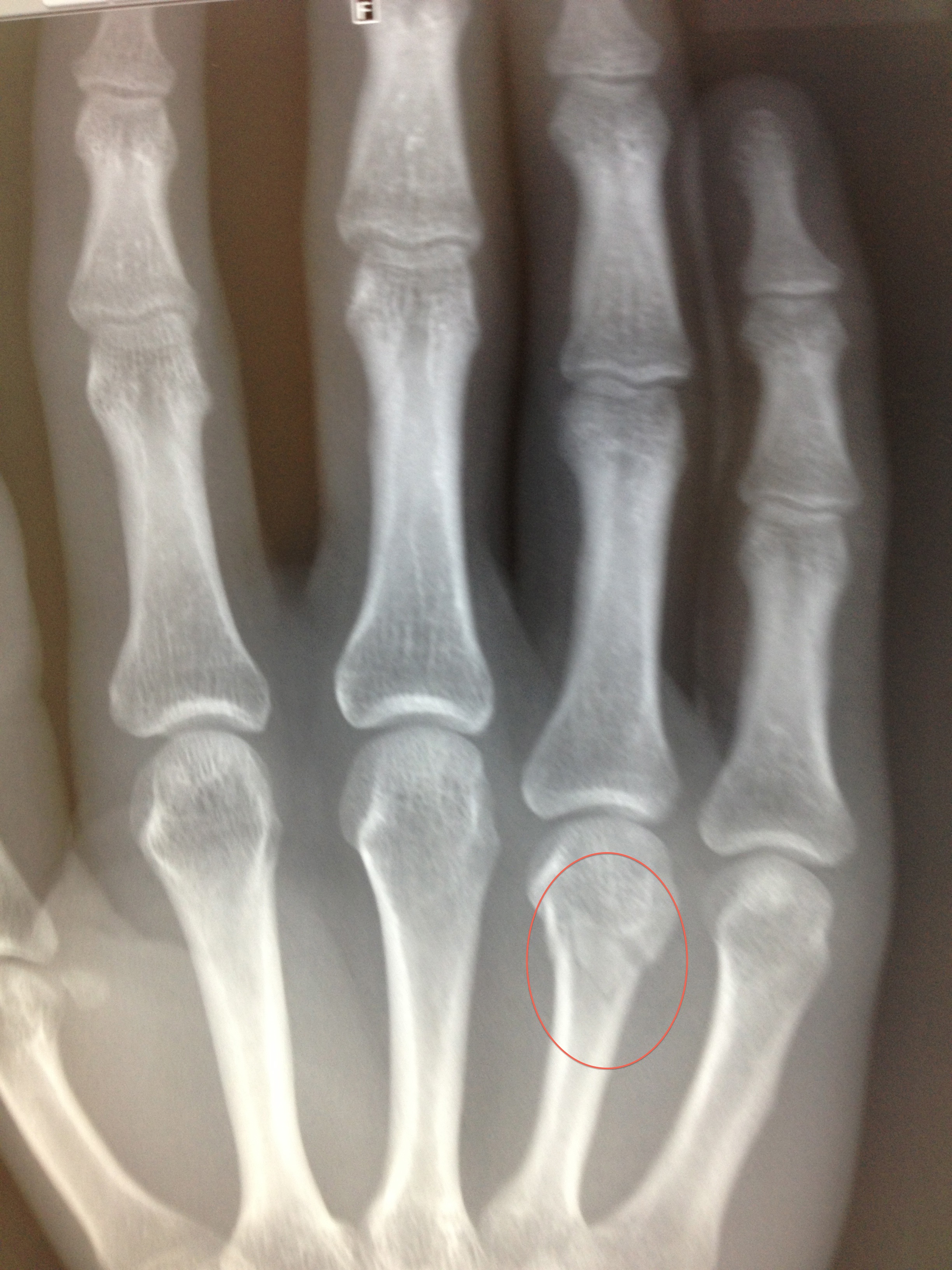 Bone physiology, Injury, Rehabilitation, Broken Hand, Broken Hand Recovery, Broken Hand Treatment, Broken Hand Exercise